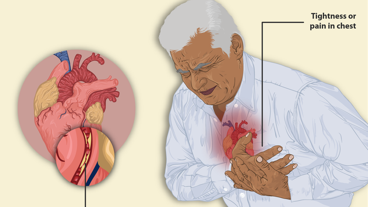 Povećan broj srčanih udara kod mlađih osoba, najčešći uzrok nezdrav način života